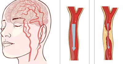 Co thắt mạch máu não là gì và có nguy hiểm không? Chuyên gia Nguyễn Văn Quýnh giải đáp