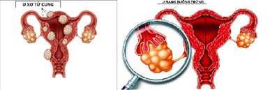 U xơ tử cung và u nang buồng trứng khác nhau như thế nào? GS.TS Nguyễn Đức Vy tư vấn