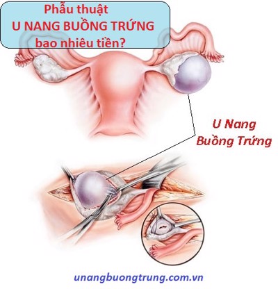 Phẫu thuật u nang buồng trứng bao nhiêu tiền? Liệu bạn có biết?