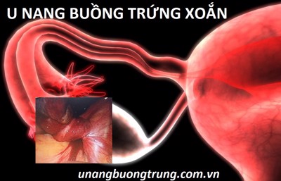 U nang buồng trứng xoắn bệnh học – Những điều có thể bạn chưa biết!