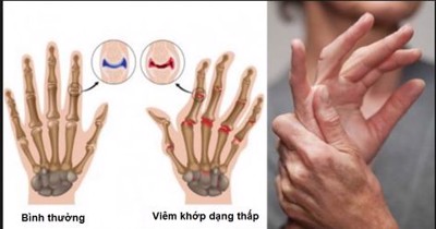 Cải thiện bệnh viêm khớp dạng thấp nhờ sản phẩm thảo dược 