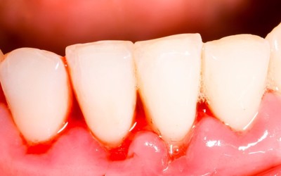 Bị chảy máu chân răng là dấu hiệu của bệnh gì? TS Phạm Hưng Củng tư vấn