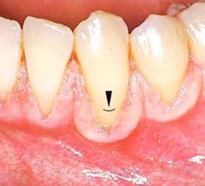3 điều cần thực hiện ngay để điều trị viêm quanh răng, tụt lợi