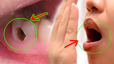Cách chữa sâu răng, hôi miệng hiệu quả là gì? PGS.TS Dương Trọng Hiếu giải đáp