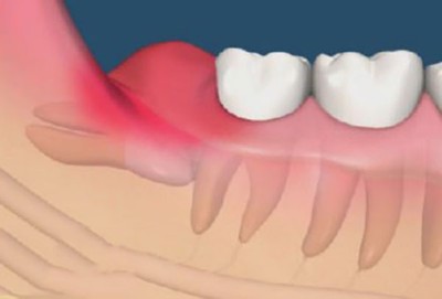 Cần phải làm gì cho đỡ đau khi mọc răng khôn hàm dưới?