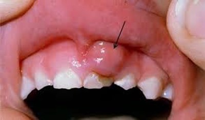 Cách điều trị chảy máu chân răng, viêm nướu tại nhà hiệu quả là gì? TS Phạm Hưng Củng tư vấn