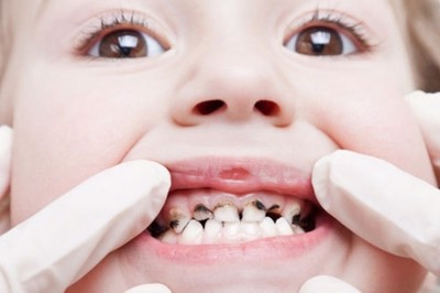 Phòng ngừa các bệnh về răng miệng ở trẻ như thế nào? Chuyên gia Nguyễn Hồng Hải giải đáp