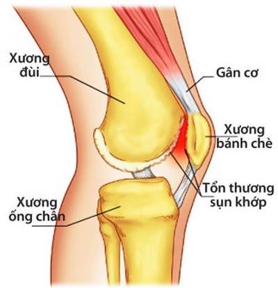 Viêm khớp đầu gối là gì? Nguyên nhân và biện pháp khắc phục hiệu quả