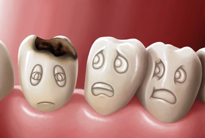 Người bị sâu răng kiêng ăn gì? Chuyên gia Phạm Hưng Củng tư vấn