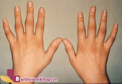 Bệnh viêm đa khớp dạng thấp và các biến chứng nguy hiểm không thể xem thường