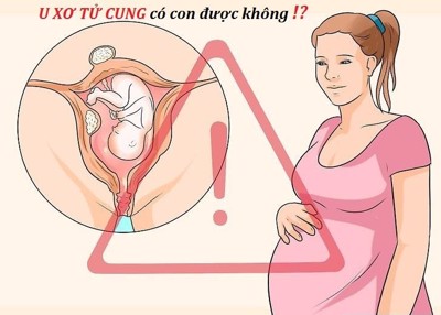 Người bị u xơ tử cung có con được không? TS Nguyễn Thị Vân Anh giải đáp