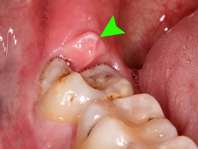  Cẩn thận mắc bệnh viêm nướu chân răng nếu gặp phải 5 dấu hiệu sau!
