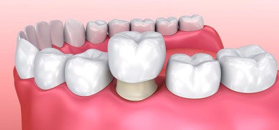 Làm răng giả, khi ăn thấy tê buốt phải làm sao? Chuyên gia Nguyễn Hồng Hải tư vấn