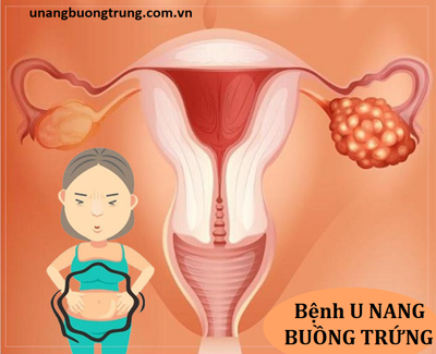 Bệnh U NANG BUỒNG TRỨNG và TOP 6 câu hỏi thường gặp!