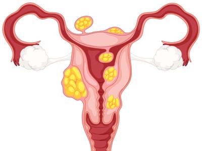 U nang buồng trứng u xơ tử cung khác nhau như thế nào? GS.TS Nguyễn Đức Vy tư vấn