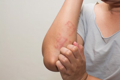 Bệnh eczema có chữa khỏi được không? Chuyên gia Nguyễn Thành tư vấn