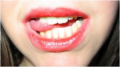 Tại sao cắn nhầm lưỡi hay môi lại gây ra nhiệt miệng?