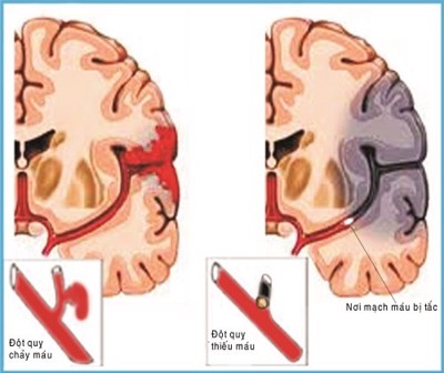 Đột quỵ não có chữa được không? Điều trị như thế nào? GS. TS. Nguyễn Văn Chương giải đáp