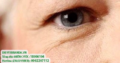 Da chảy xệ vùng mắt – Nguyên nhân và cách “cứu nguy” hiệu quả