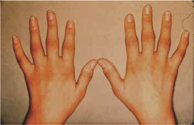 Bệnh viêm khớp dạng thấp có điều trị khỏi được không? Chuyên gia Nguyễn Thị Lực tư vấn
