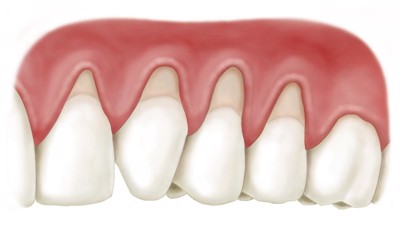 Bí quyết khắc phục viêm chân răng hiệu quả bằng dụng dịch nha khoa của ông Phon (ĐT: 0908358280)