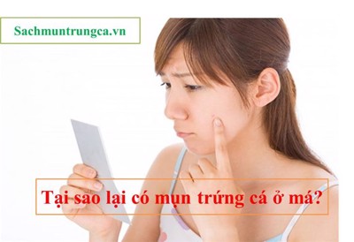  Mụn trứng cá ở má, nguyên nhân do đâu? Tìm hiểu ngay