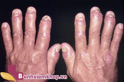 8 biện pháp khắc phục các triệu chứng bệnh viêm khớp dạng thấp hiệu quả