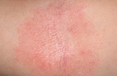 Trẻ bị nổi ban đỏ trên mặt, dễ tái phát có phải viêm da dị ứng không?