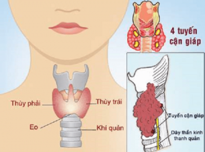 Khi bướu tuyến giáp có dấu hiệu biến dạng, đau vùng cổ thì bệnh đã ở giai đoạn nào?