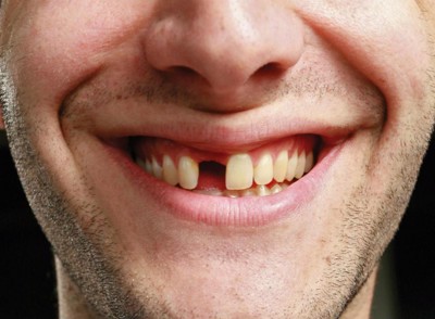 Bí quyết thoát khỏi nỗi lo bị rụng răng nhờ dung dịch Nutridentiz của ông Phon (ĐT: 0908358280)