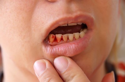 Bí quyết đẩy lùi viêm lợi, chảy máu chân răng của ông Phon (ĐT: 0908358280)