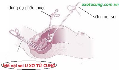 Mổ nội soi u xơ tử cung và những điều có thể bạn chưa biết