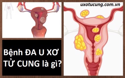 Đa u xơ tử cung là gì và có nguy hiểm không?