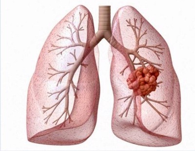 Ung thư phổi là gì? Những nguy cơ nào có thể dẫn đến tình trạng ung thư phổi?