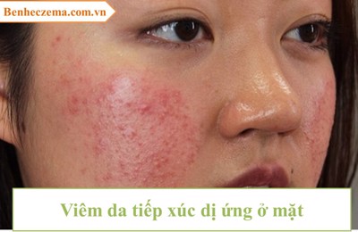 Bệnh viêm da tiếp xúc dị ứng ở mặt và cách khắc phục hiệu quả