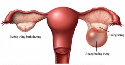 Khi có bầu bị u nang buồng trứng có sao không? GS.TS Nguyễn Đức Vy tư vấn