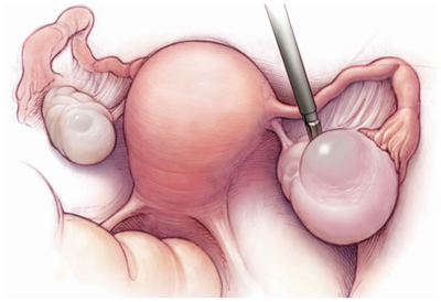 Bị u nang buồng trứng phải kích thước 50x51mm, có xoắn, nên mổ hay điều trị bằng thuốc?