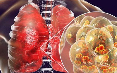 Bạn biết những gì về bệnh viêm phổi do vi khuẩn gây nên?