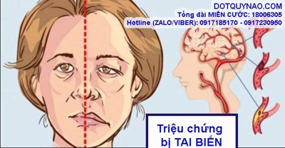 Những triệu chứng bị TAI BIẾN mạch máu não là gì? Xử trí ra sao?