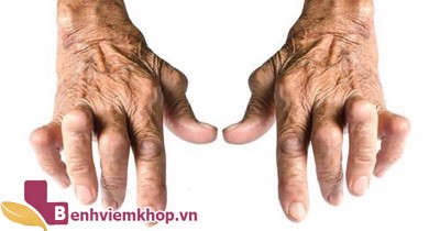 Chữa viêm khớp dạng thấp bằng thuốc nam thực hiện như thế nào?