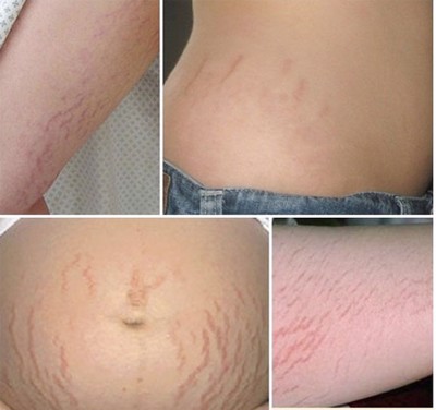 Lạm dụng Corticoid trong điều trị rạn da sau sinh mổ sẽ gây ra những hệ lụy gì?