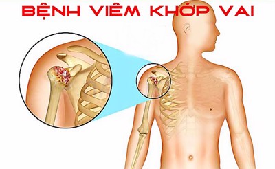 Bị viêm khớp vai nên dùng thuốc như thế nào cho hiệu quả? PGS. TS Dương Trọng Hiếu tư vấn