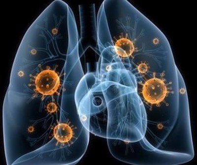 Viêm phổi hoại tử là gì? Nguyên nhân, triệu chứng và cách phòng ngừa bệnh hiệu quả