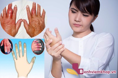  Bệnh viêm khớp dạng thấp có chữa khỏi không? – Xem ngay để biết!