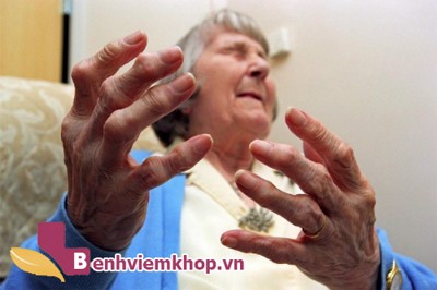 2 bài thuốc chữa viêm khớp dạng thấp hiệu quả từ hy thiêm