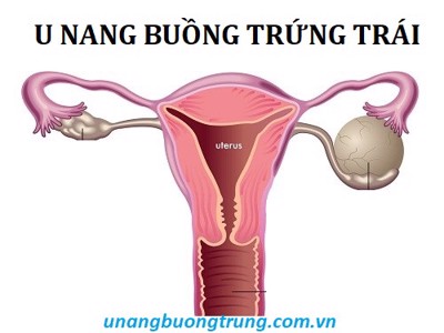 Dấu hiệu u nang buồng trứng trái và cách điều trị bệnh!