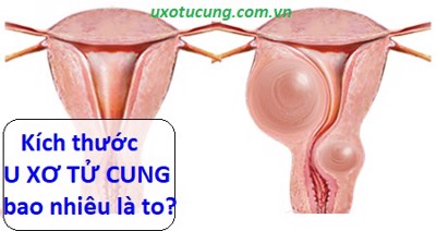 GIẢI ĐÁP THẮC MẮC: Kích thước u xơ tử cung bao nhiêu là to?