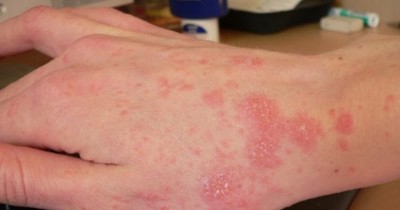 Triệu chứng của viêm da cơ địa có phải là ngứa dữ dội, chảy nước vàng ở chân?