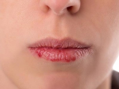 Bệnh chàm môi nên bôi thuốc gì? Chuyên gia Nguyễn Thành tư vấn