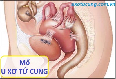 Đừng vội mổ u xơ tử cung nếu bạn chưa biết điều này!?